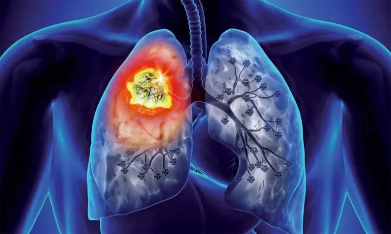 Le-cancer-du-poumon